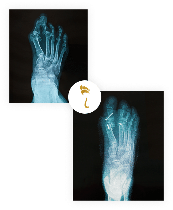 podiatric bunion foot x-ray