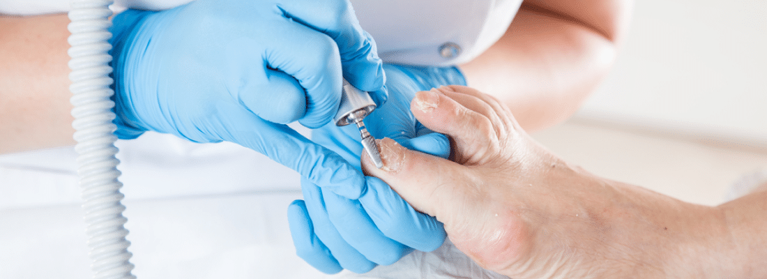 ingrown toenail treatment procedure