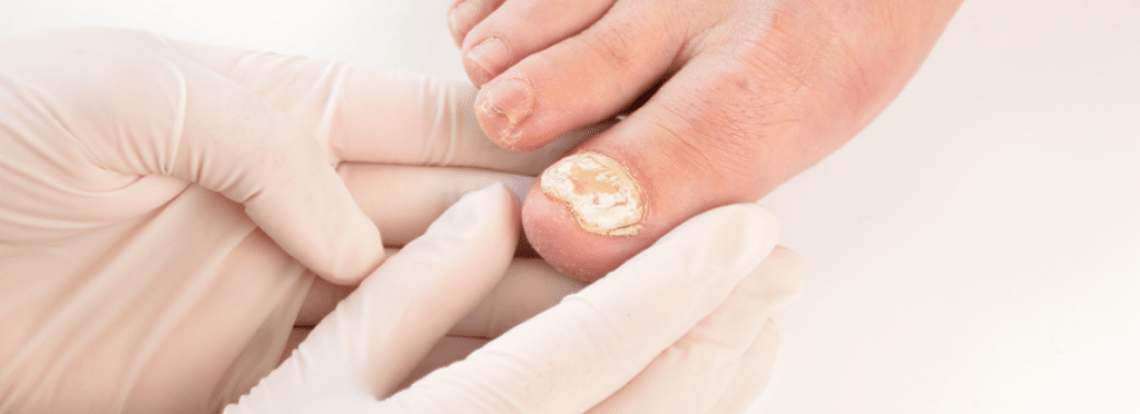 toenail fungus exam